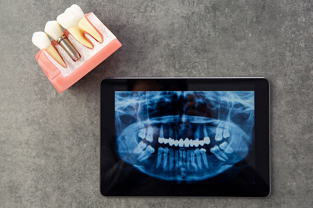 임플란트는 웃는 일상을 되찾아주는 과정
