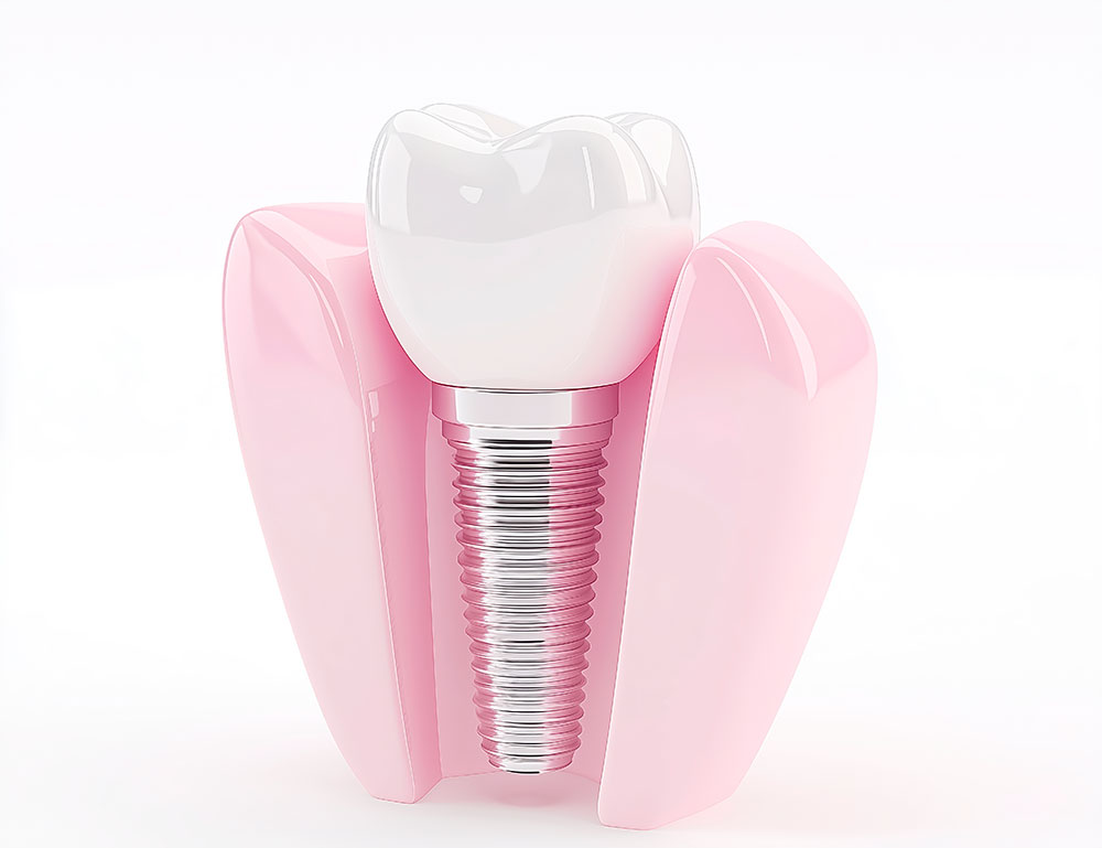 임플란트는 고난도 시술, 더끌림치과의원